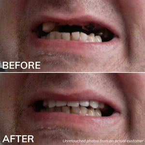 Before and After Photos with the Ultimate Denturas Kit